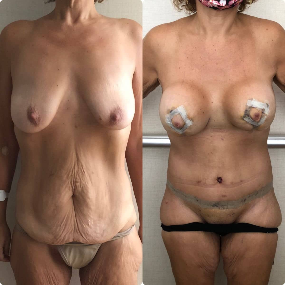 Case 19588 - mommy makeover