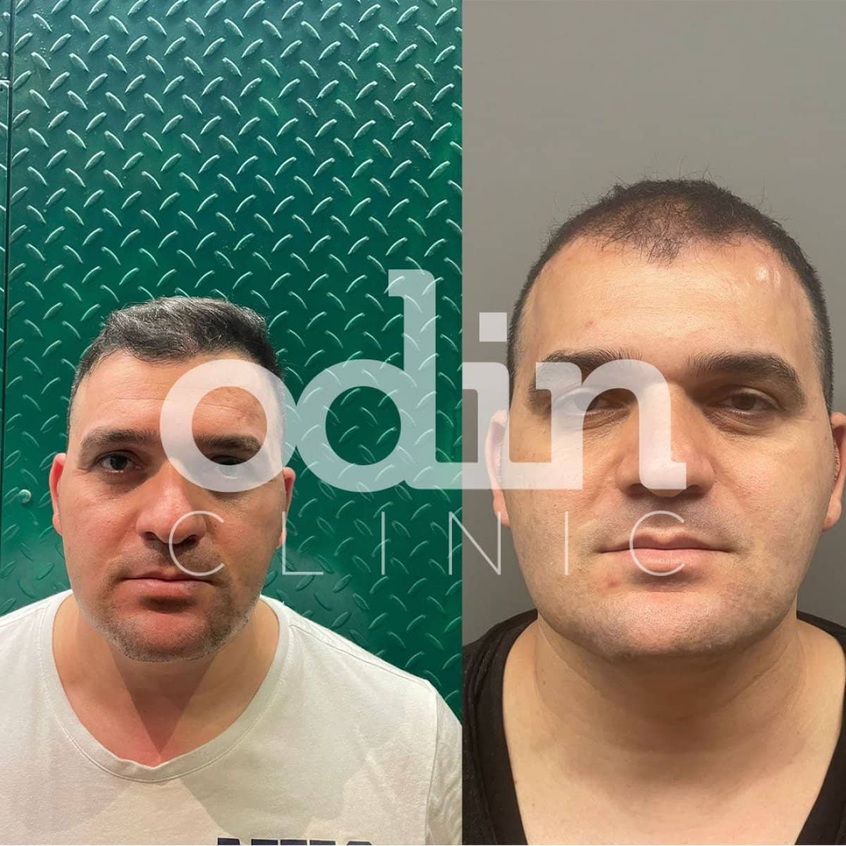 Case 19589 - FUE hair transplant