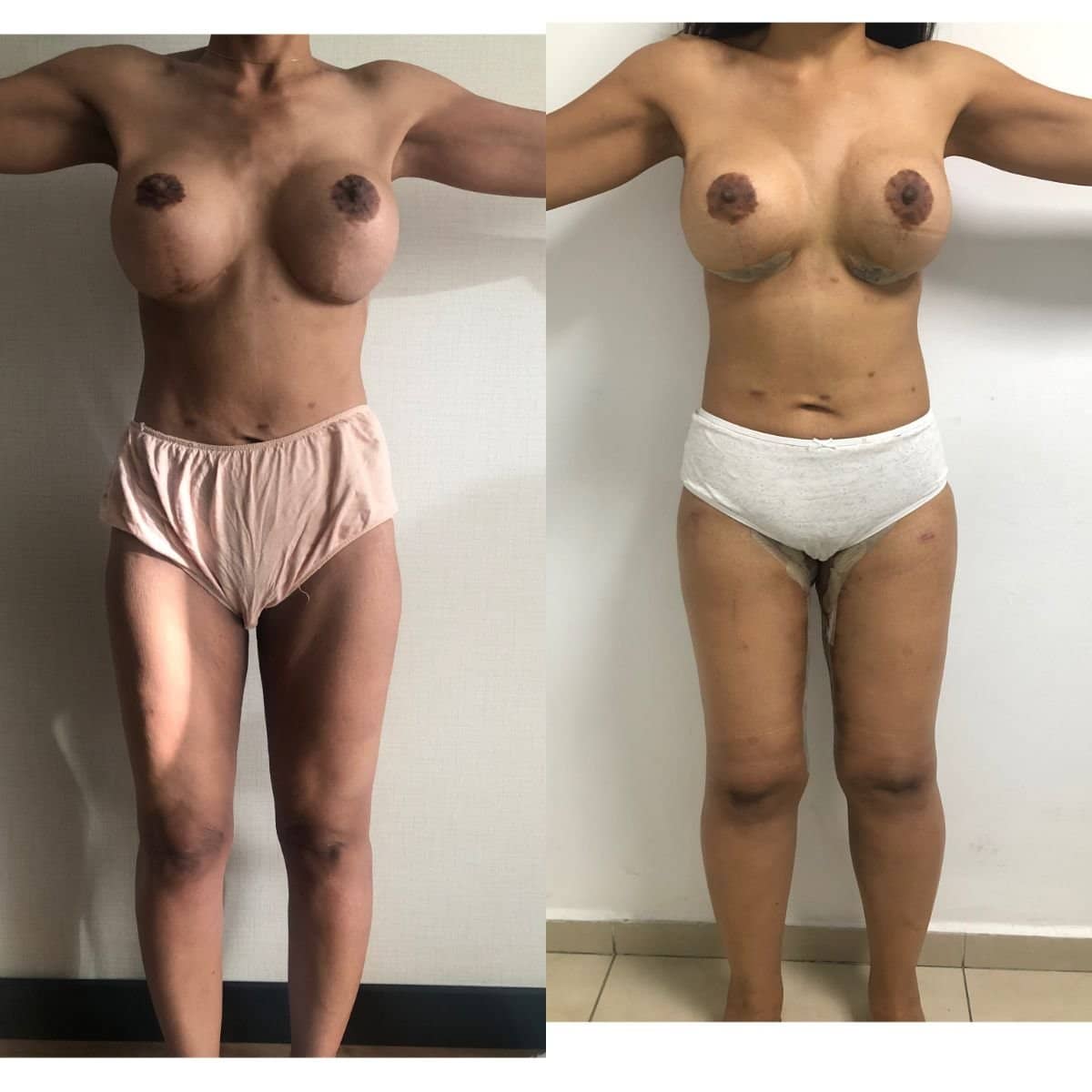 Case 19591 - breast lift