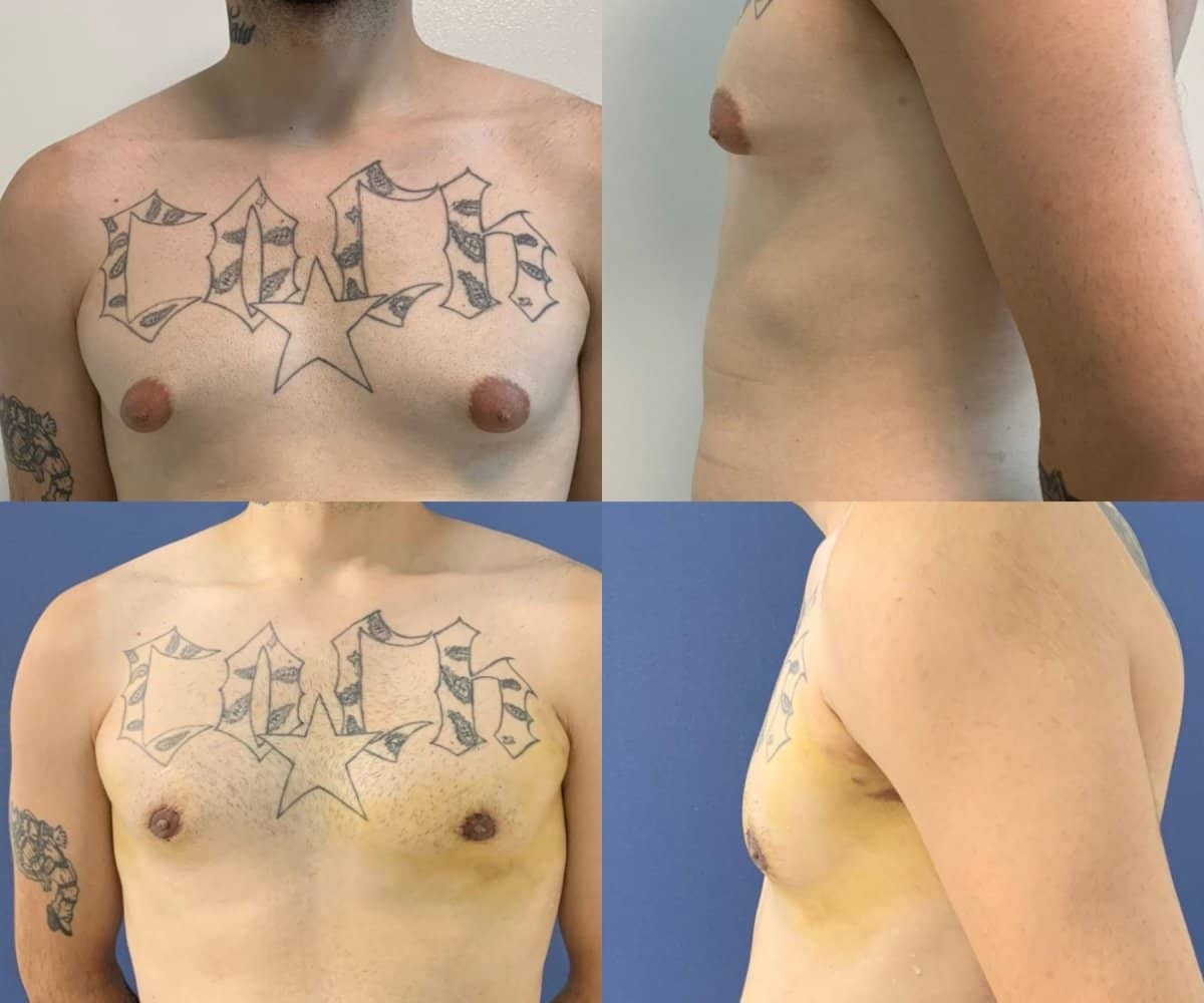 Case 19605 - gynecomastia surgery
