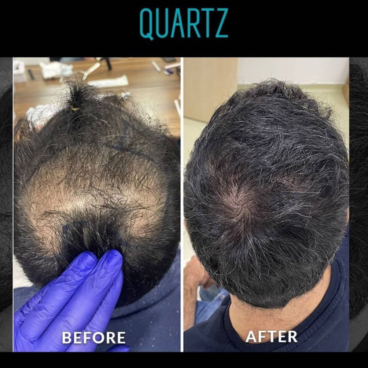 Case 19606 - No Shave Hair Transplant