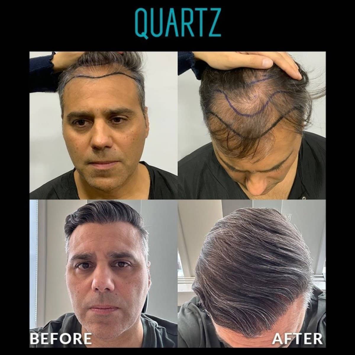 Case 19609 - No Shave Hair Transplant