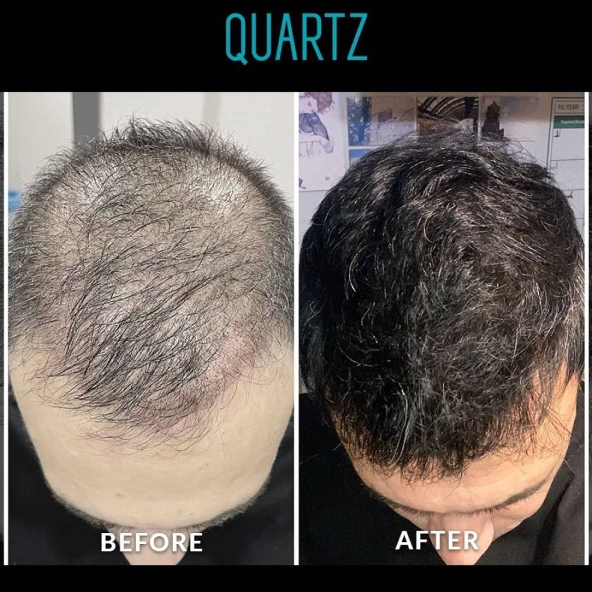 Case 19610 - No Shave Hair Transplant