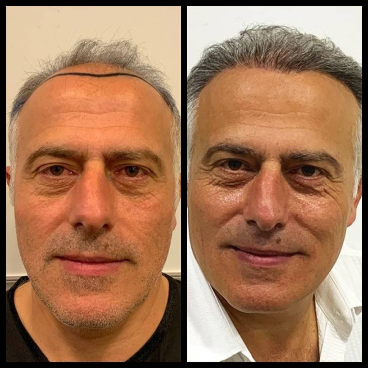 Case 19611 - No Shave Hair Transplant