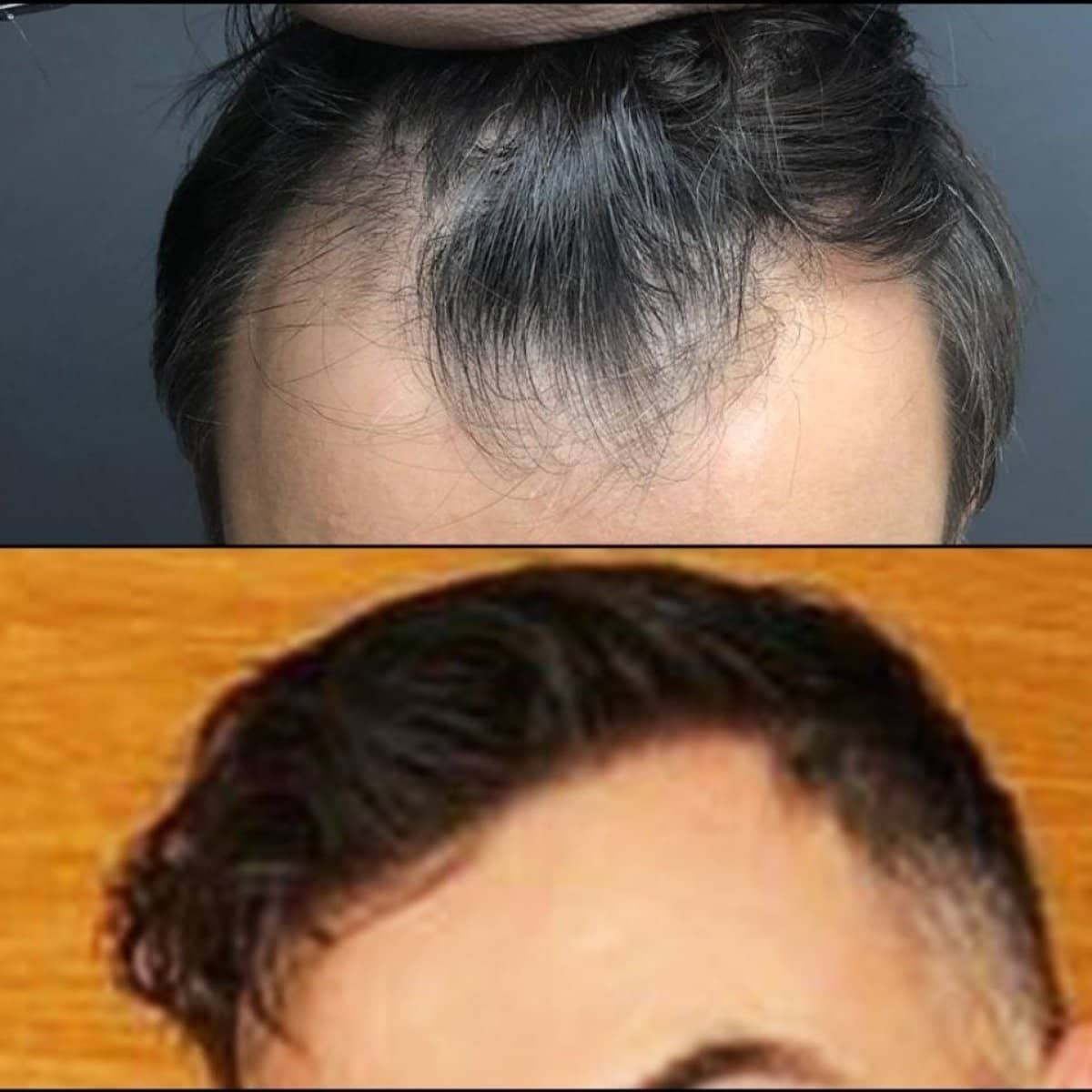Case 19614 - no shave hair transplant
