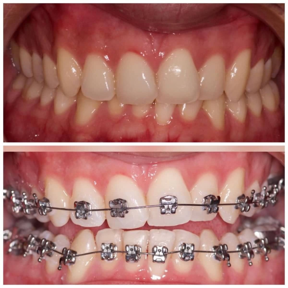 Case 19647 - braces treatment