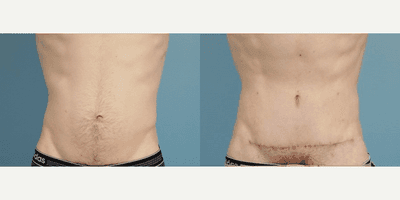 Case 1968 - Man treated with Tummy Tuck