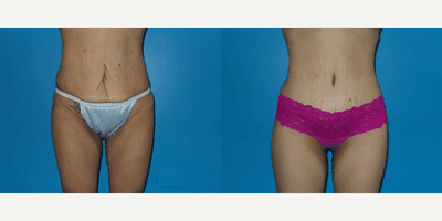 Case 1969 - Woman treated with Tummy Tuck