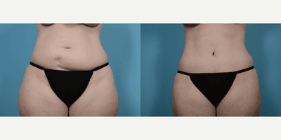 Case 1970 - Woman treated with Tummy Tuck