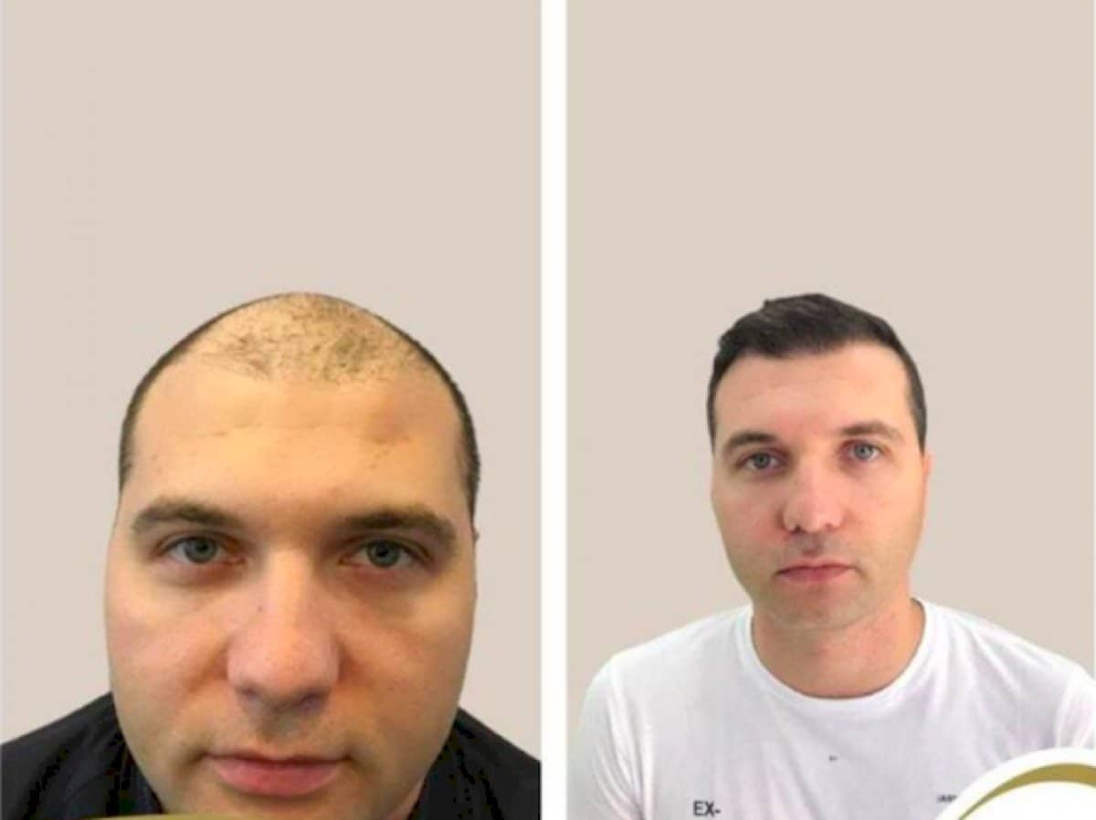 Case 19707 - FUE hair transplant