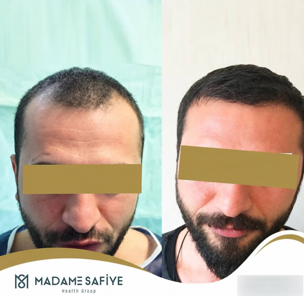 Case 19708 - FUE hair transplant