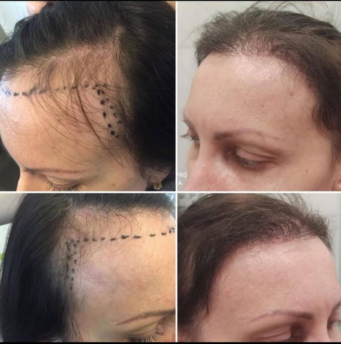 Case 19709 - hair transplant