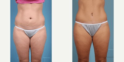 Case 1971 - Woman treated with Tummy Tuck
