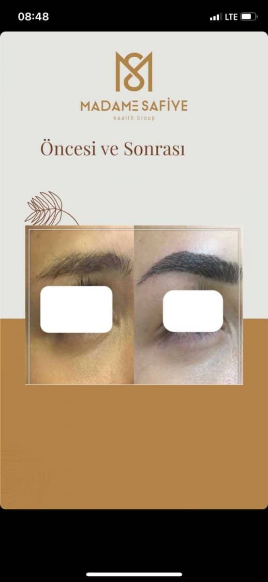 Case 19710 - eyebrow transplantation
