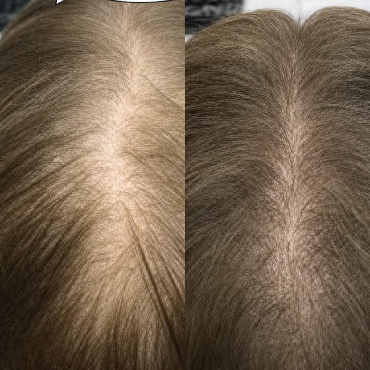 Case 19713 - hair transplant