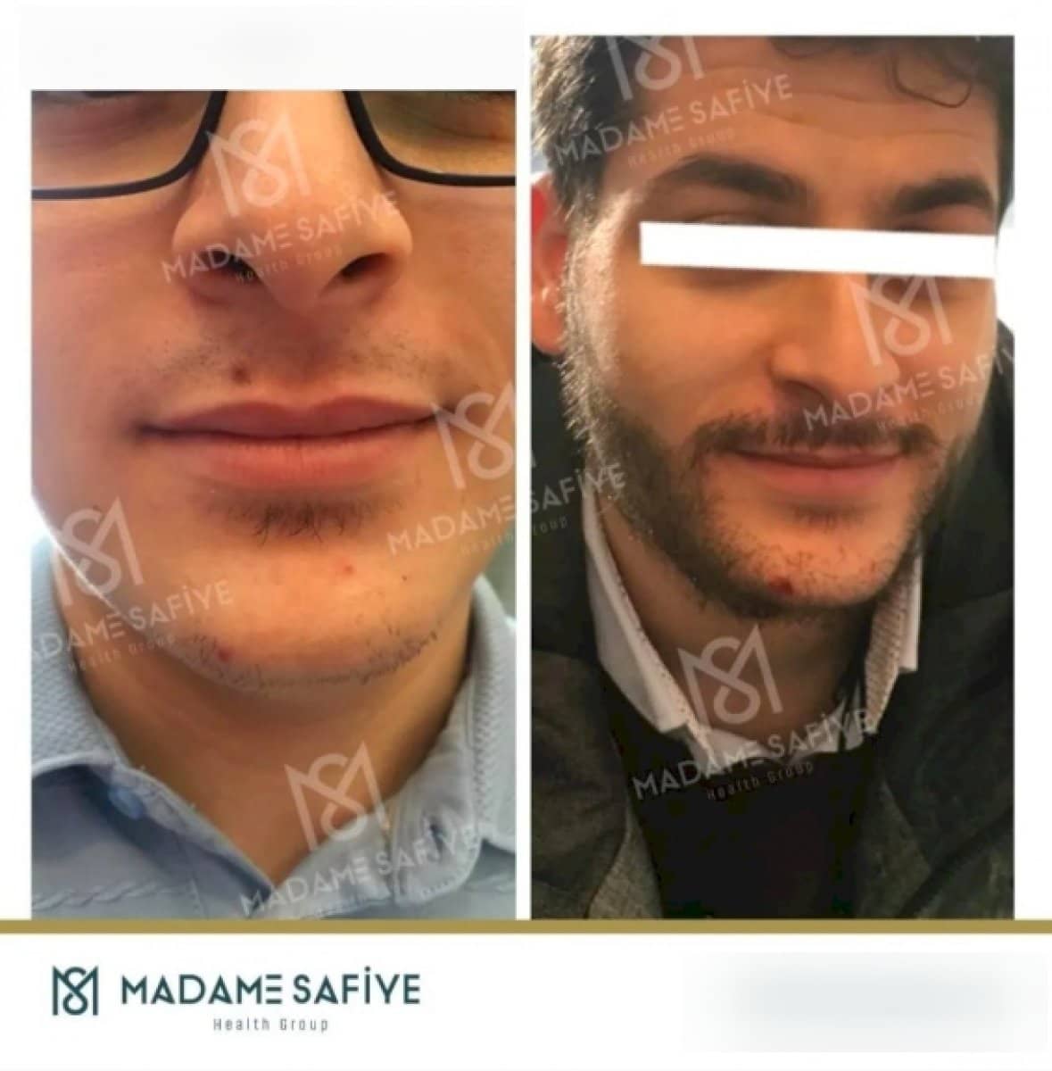 Case 19714 - beard transplant