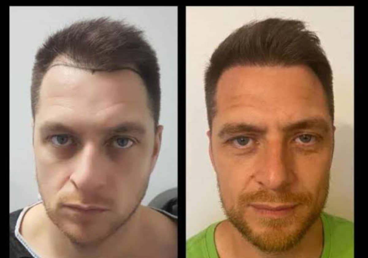 Case 19715 - No Shave Hair Transplant