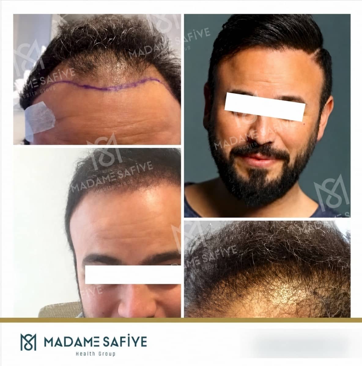 Case 19716 - FUE hair transplant