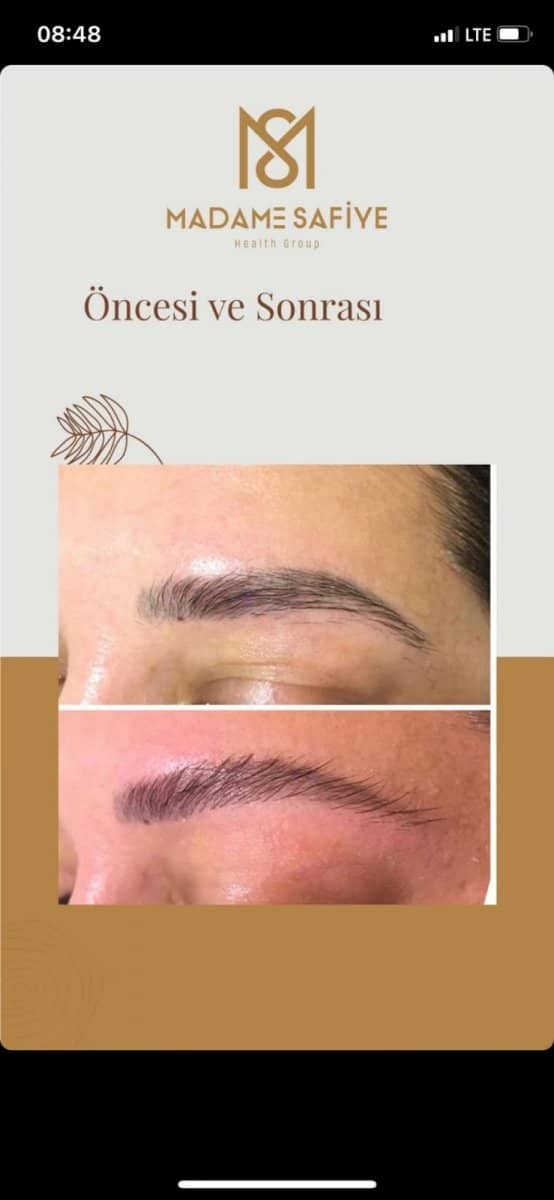 Case 19717 - eyebrow transplantation
