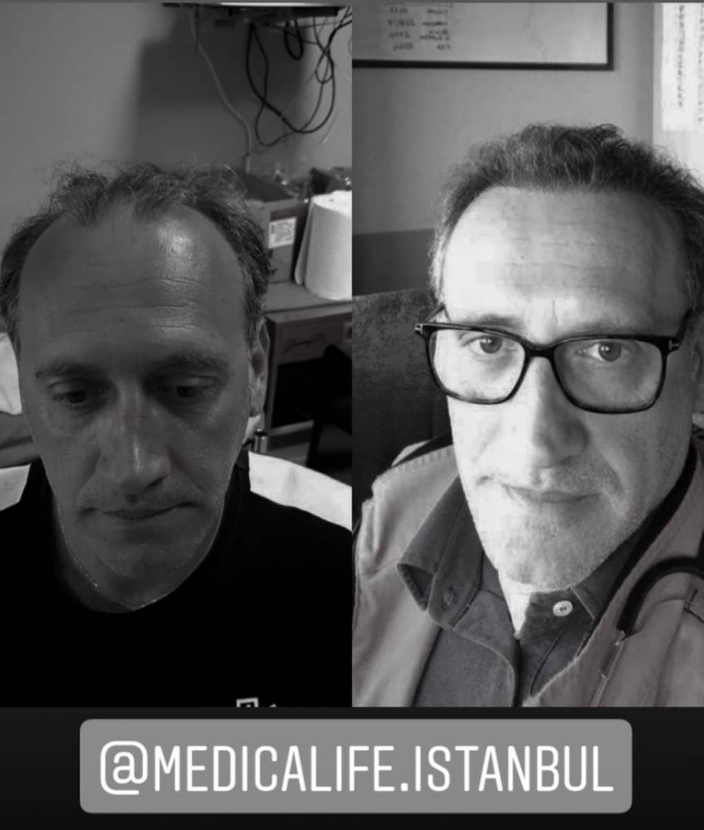 Case 19718 - No Shave Hair Transplant
