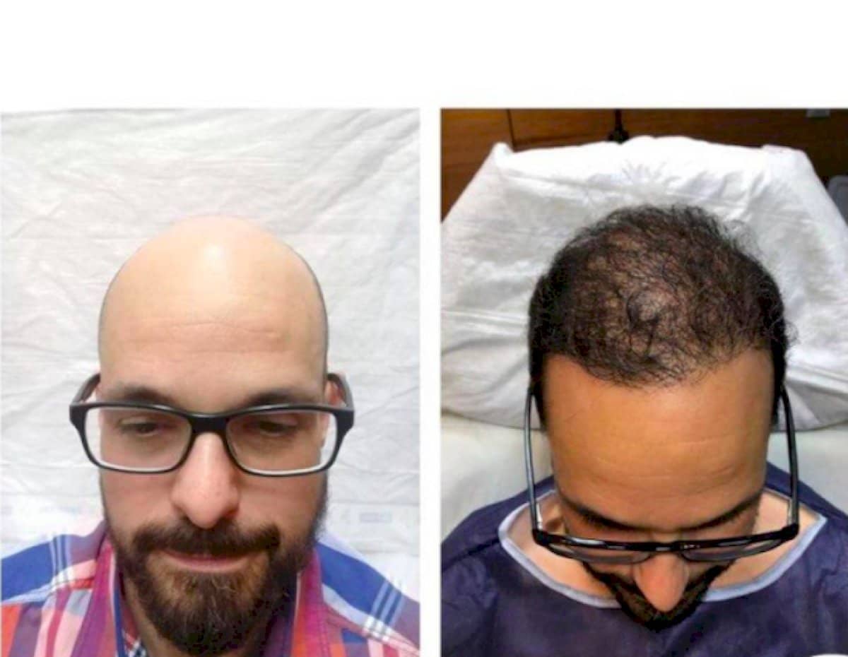 Case 19720 - FUE hair transplant