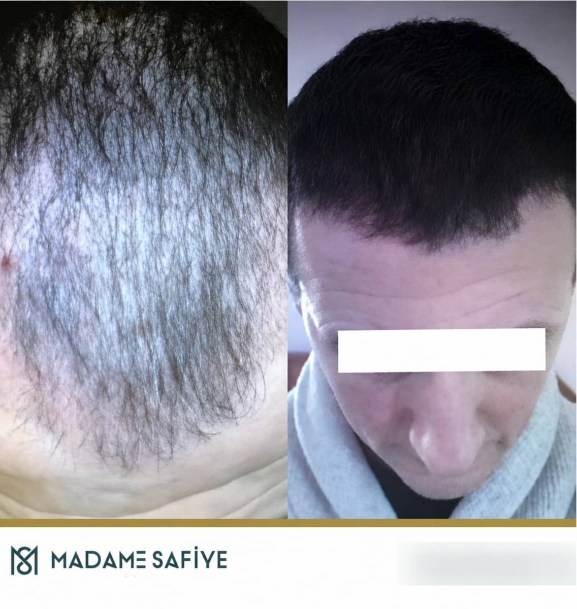 Case 19726 - FUE hair transplant