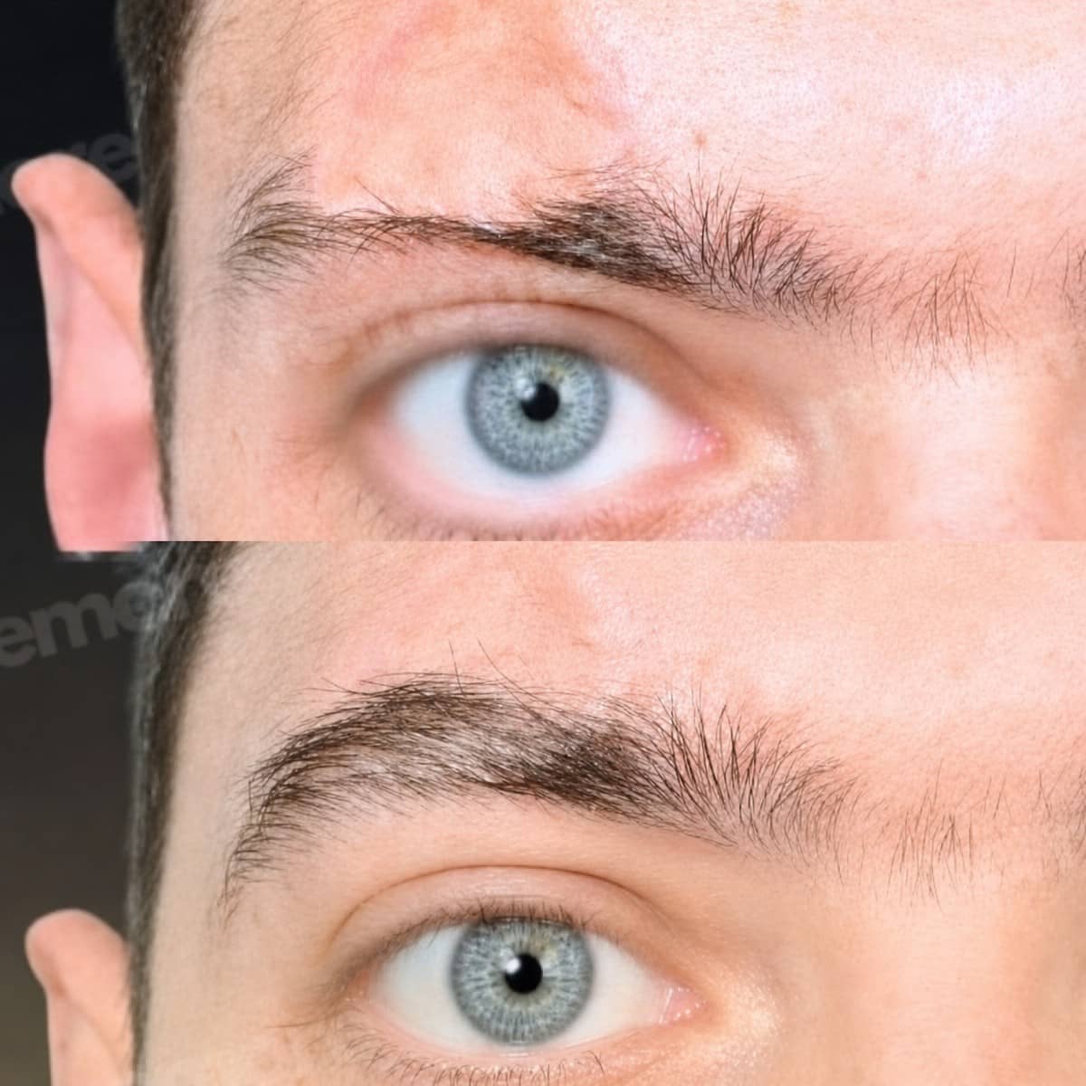 Case 19739 - eyebrow transplantation