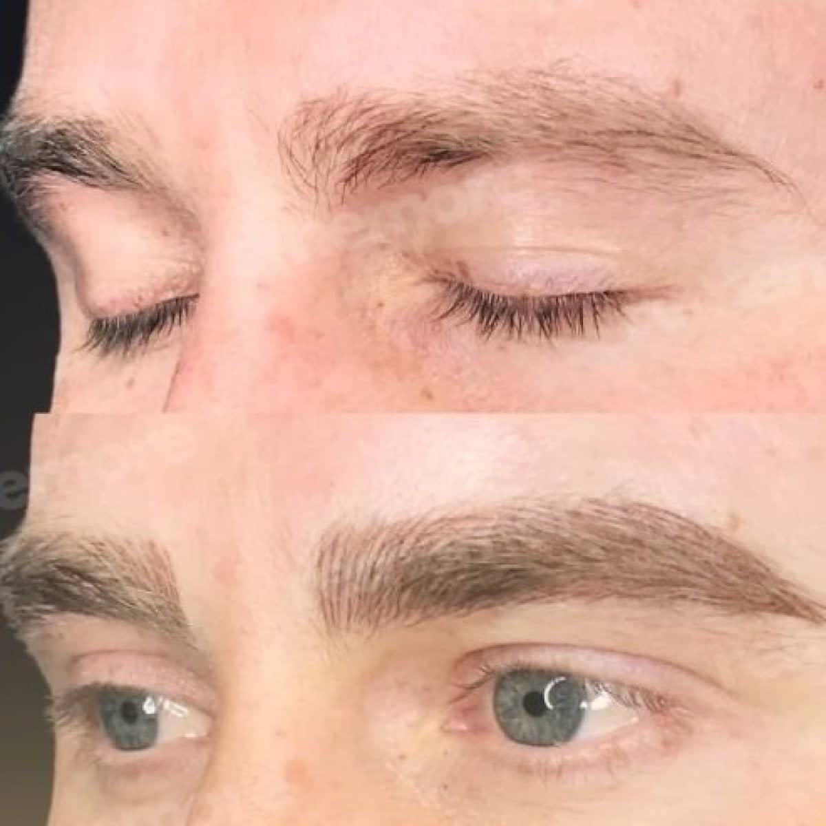 Case 19740 - eyebrow transplantation