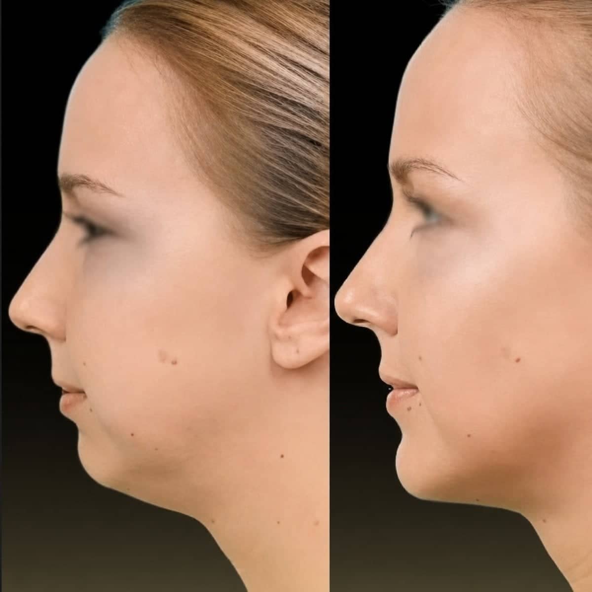 Case 19742 - jaw shaping