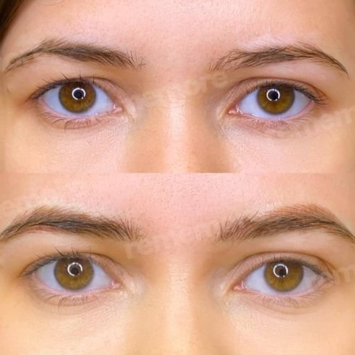 Case 19743 - eyebrow transplantation