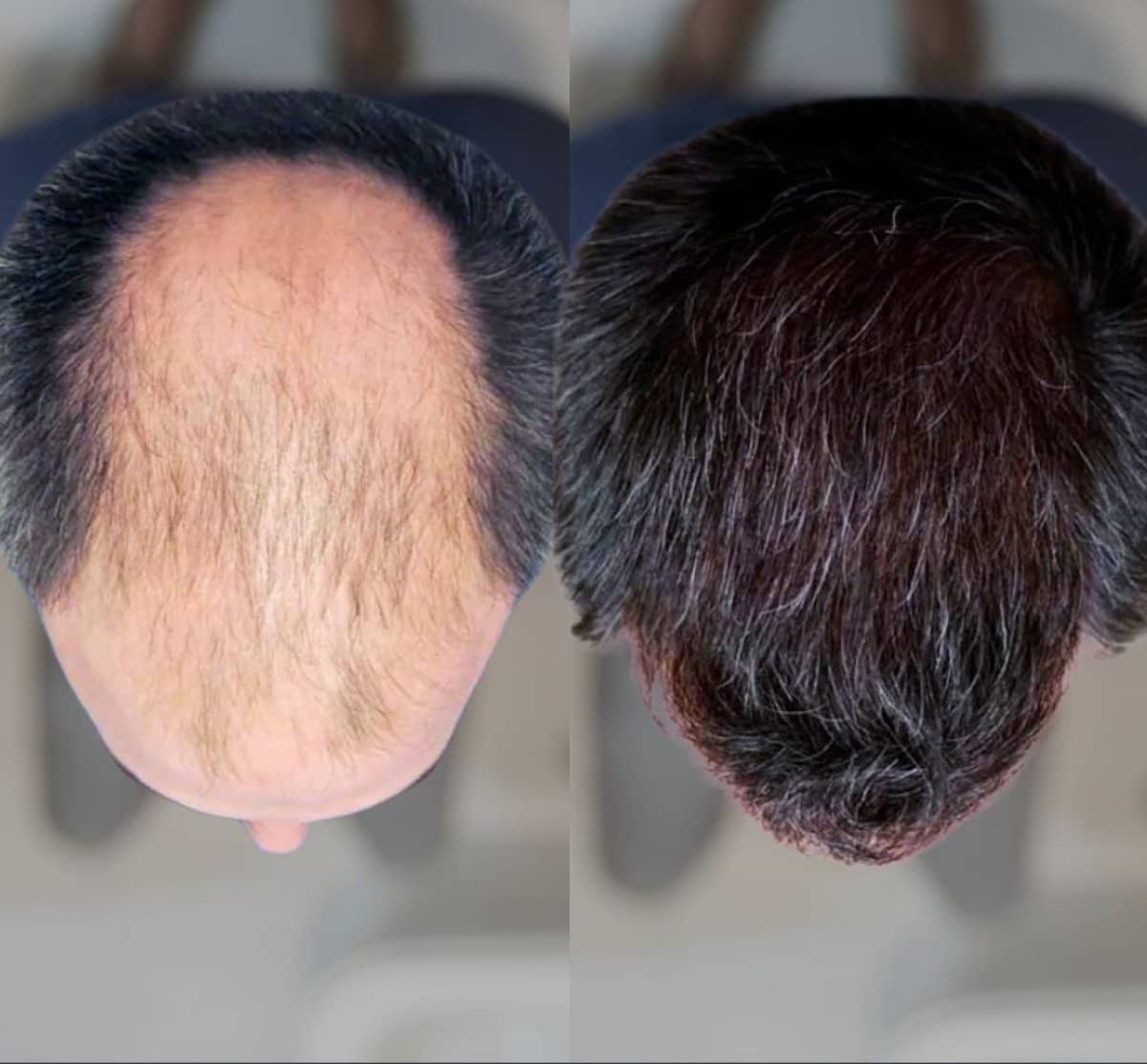 Case 19745 - DHI hair transplant