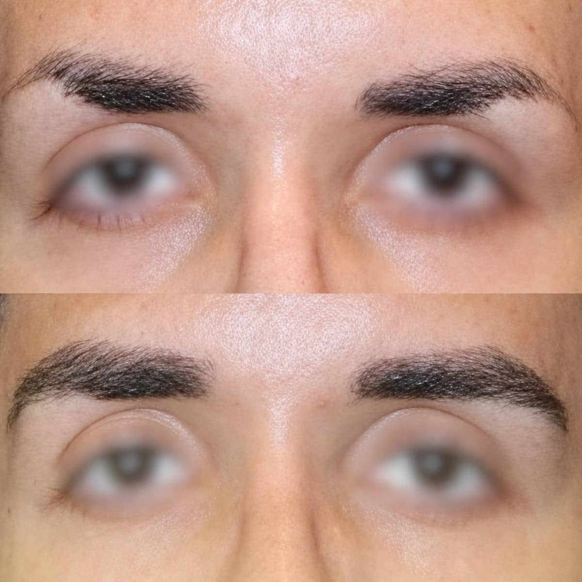 Case 19749 - eyebrow transplantation