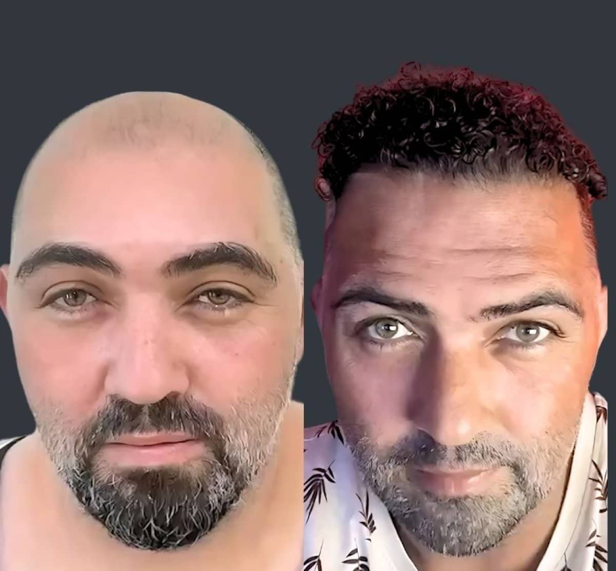 Case 19751 - DHI hair transplant
