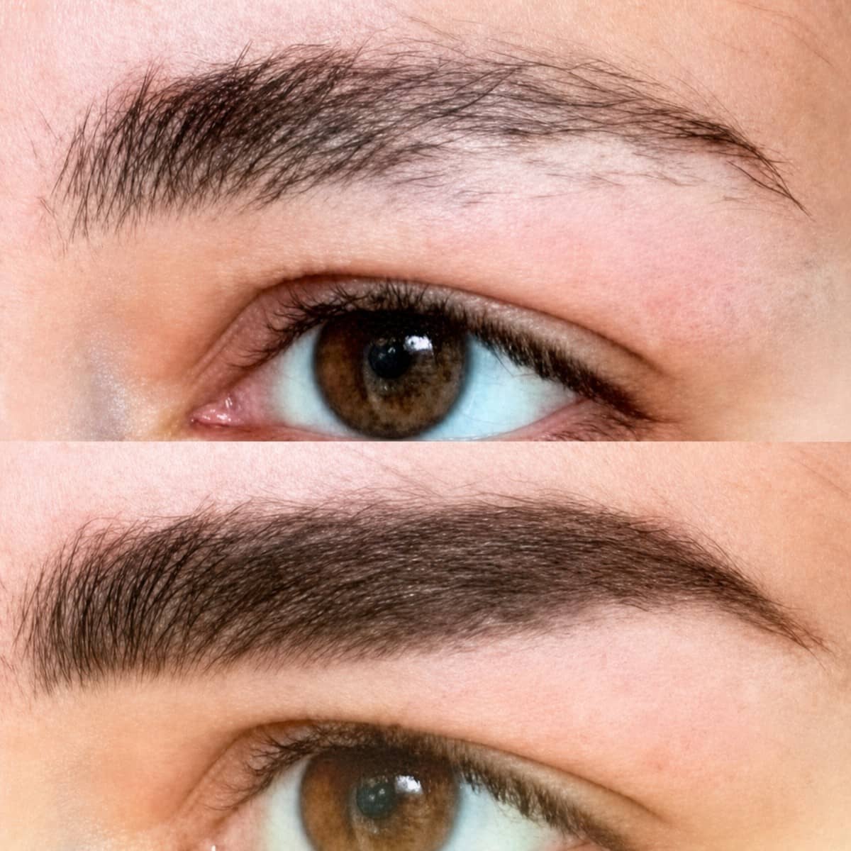 Case 19752 - eyebrow transplantation