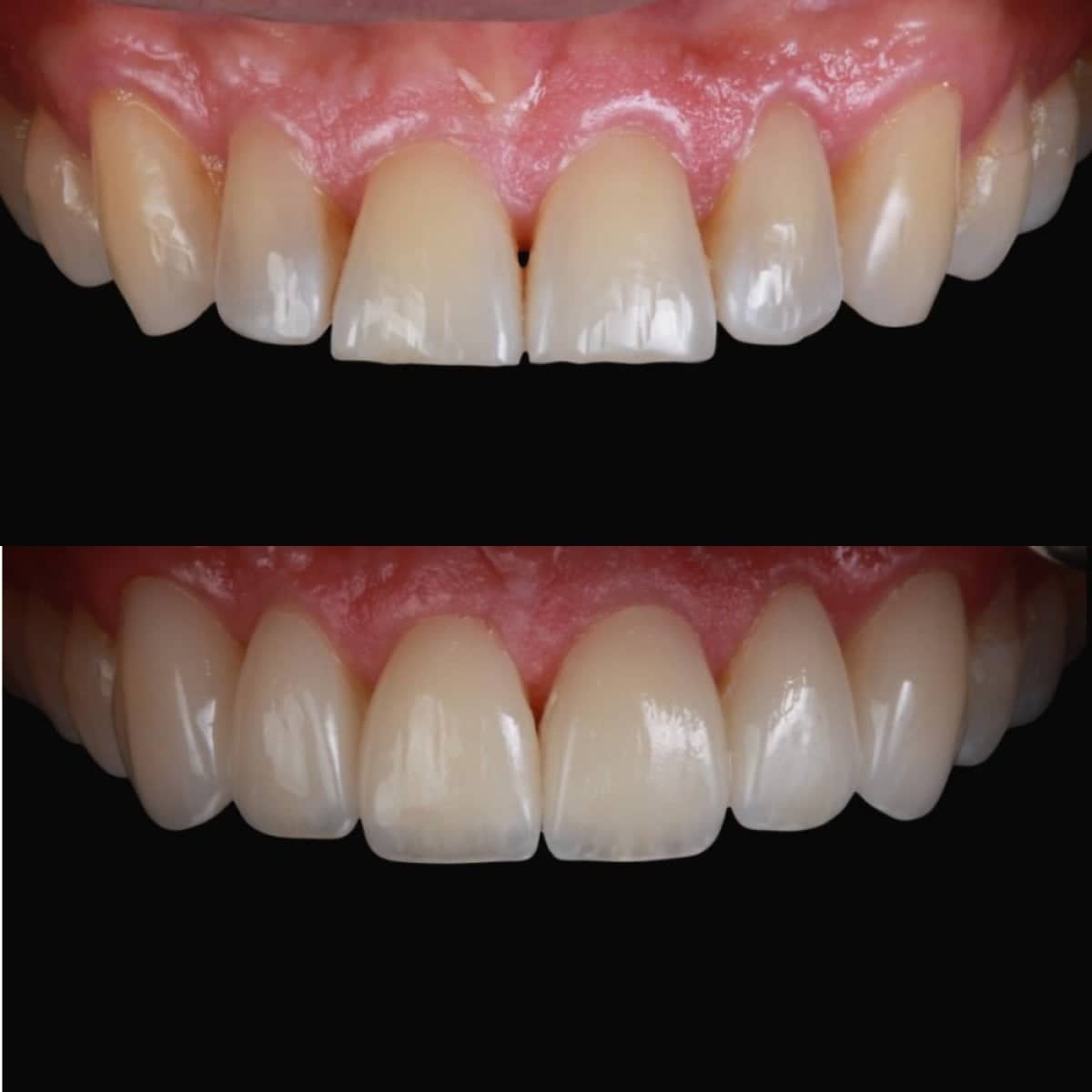 Case 19808 - porcelain veneer