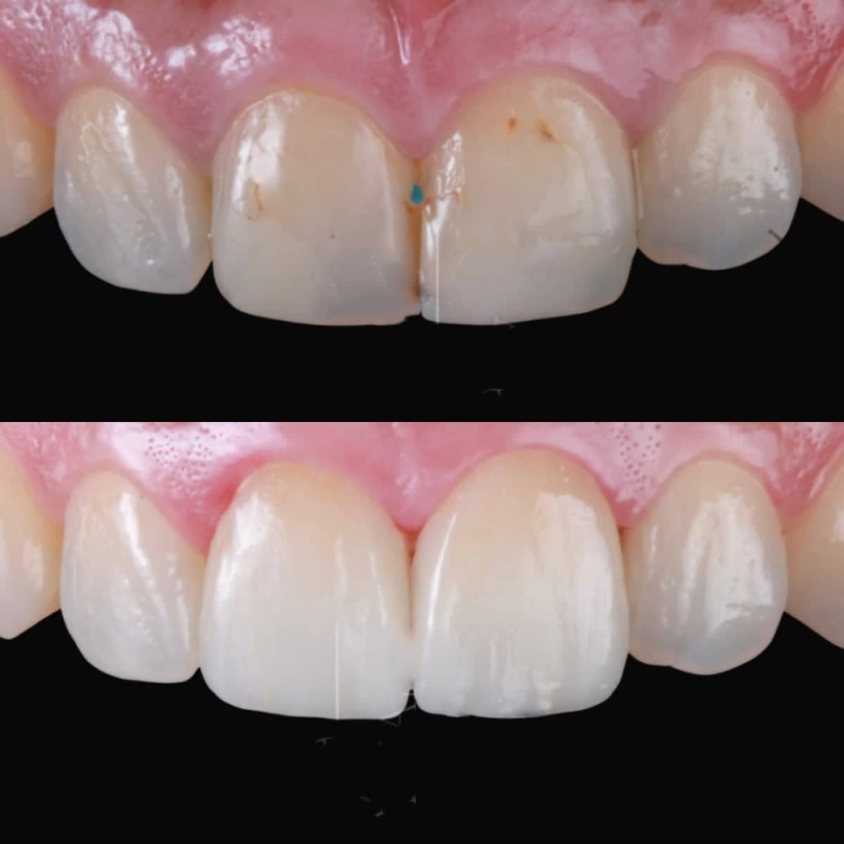 Case 19809 - porcelain veneer