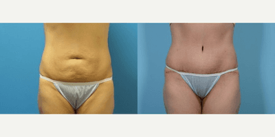 Case 1981 - Woman treated with Tummy Tuck