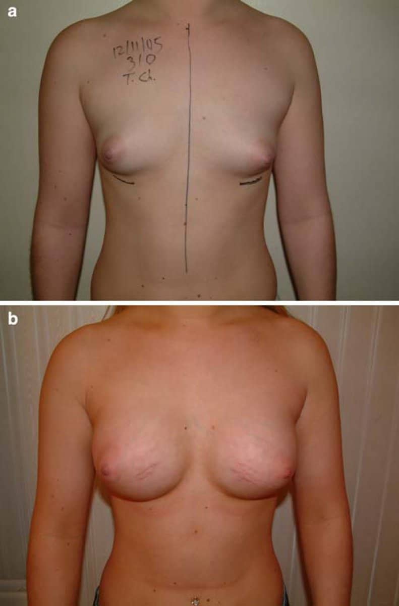 Case 19817 - breast augmentation