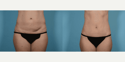 Case 1982 - Woman treated with Tummy Tuck
