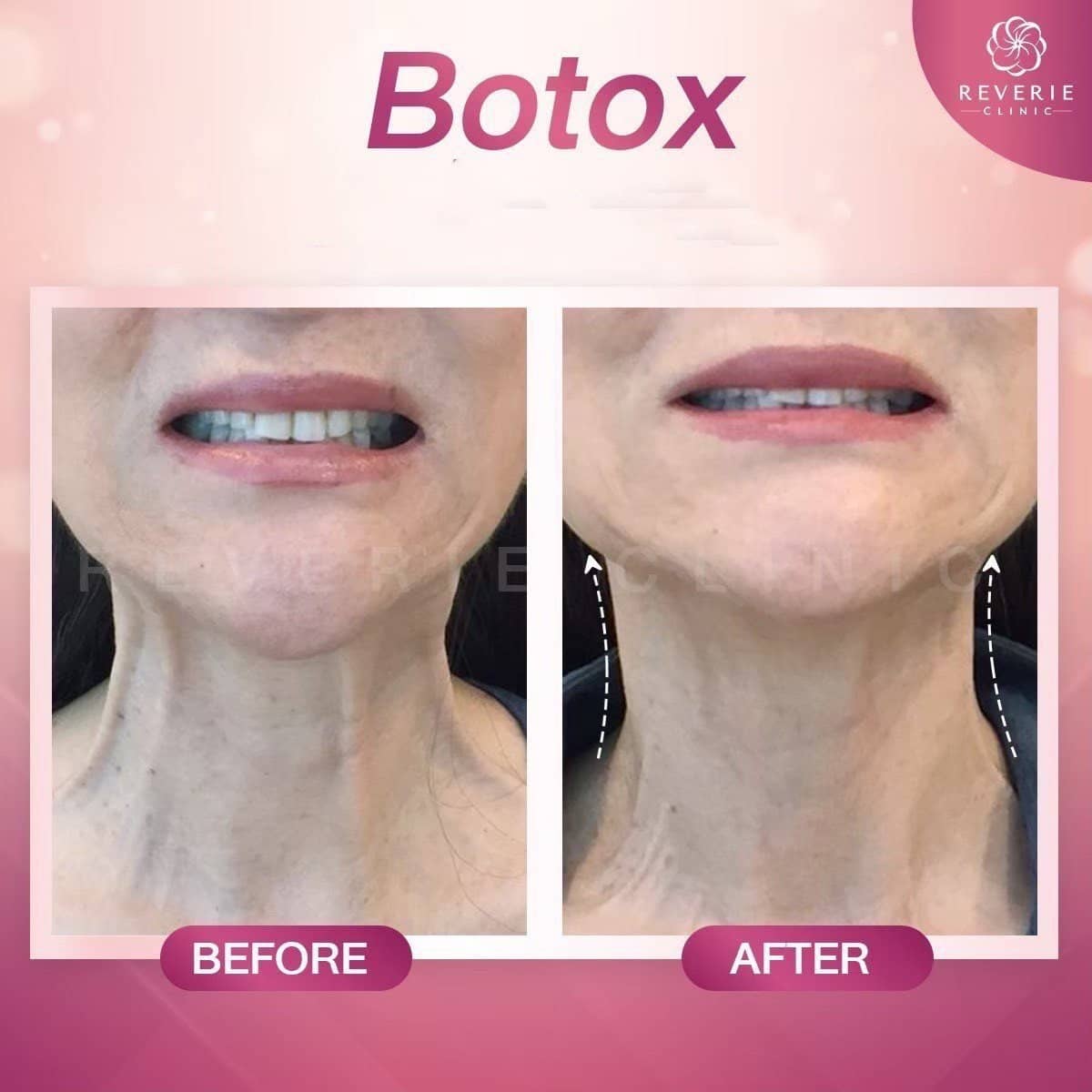Case 19822 - Botox injections