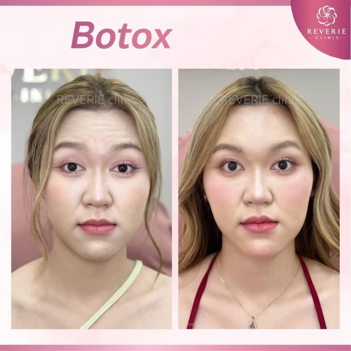 Case 19823 - Botox injections