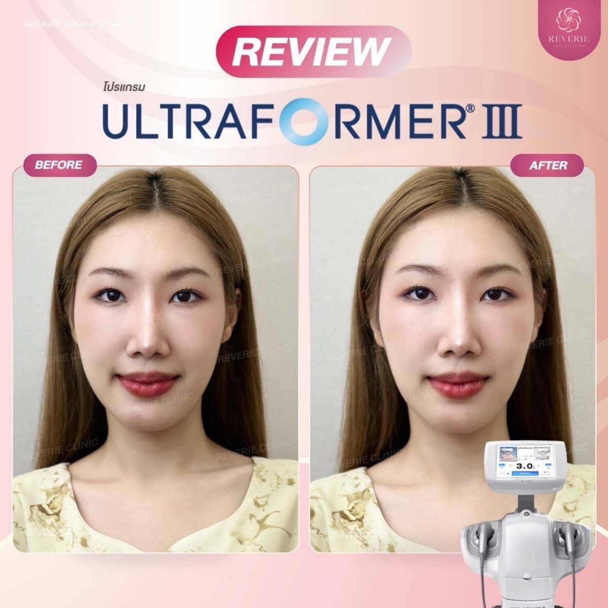 Case 19825 - nonsurgical facelift