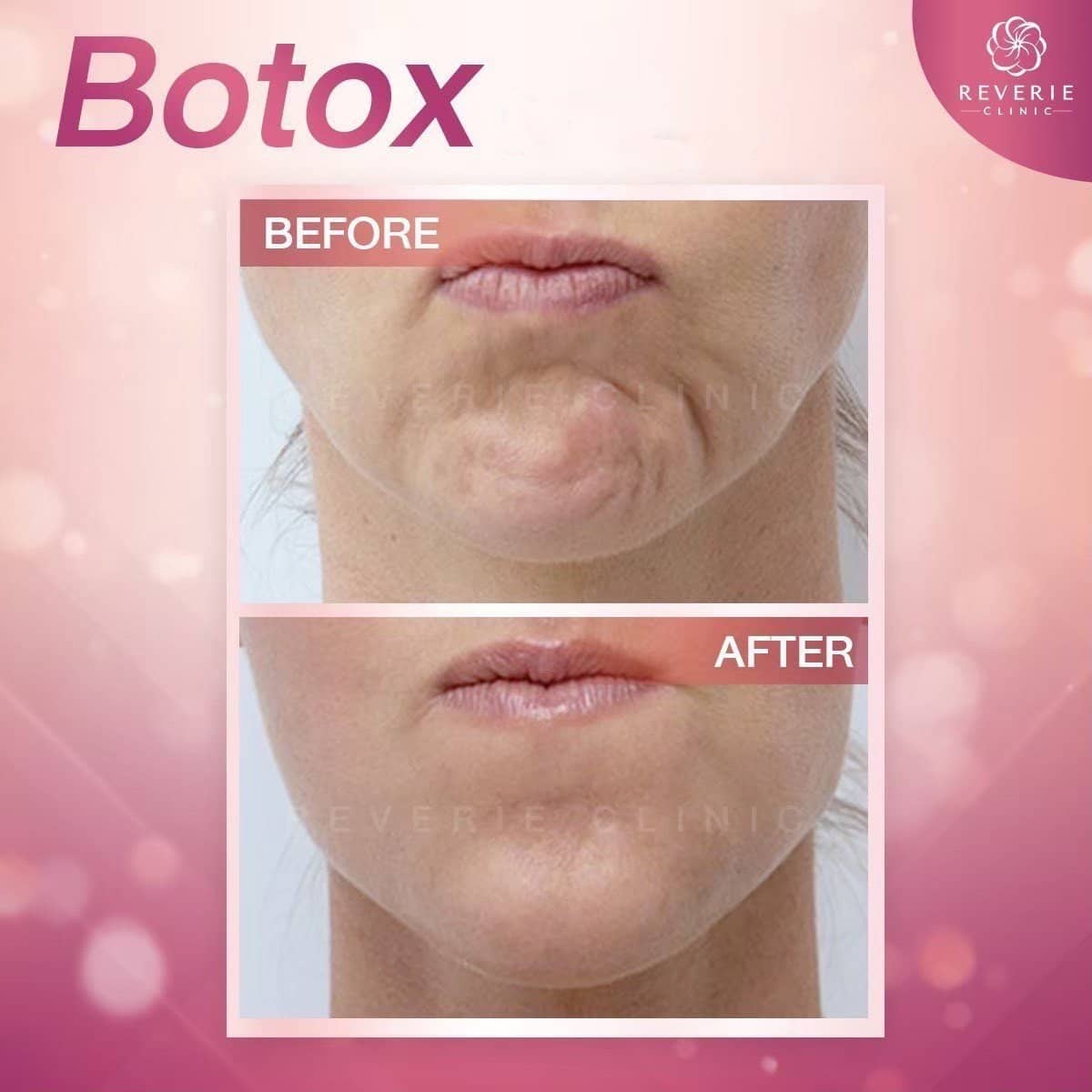 Case 19826 - Botox injections