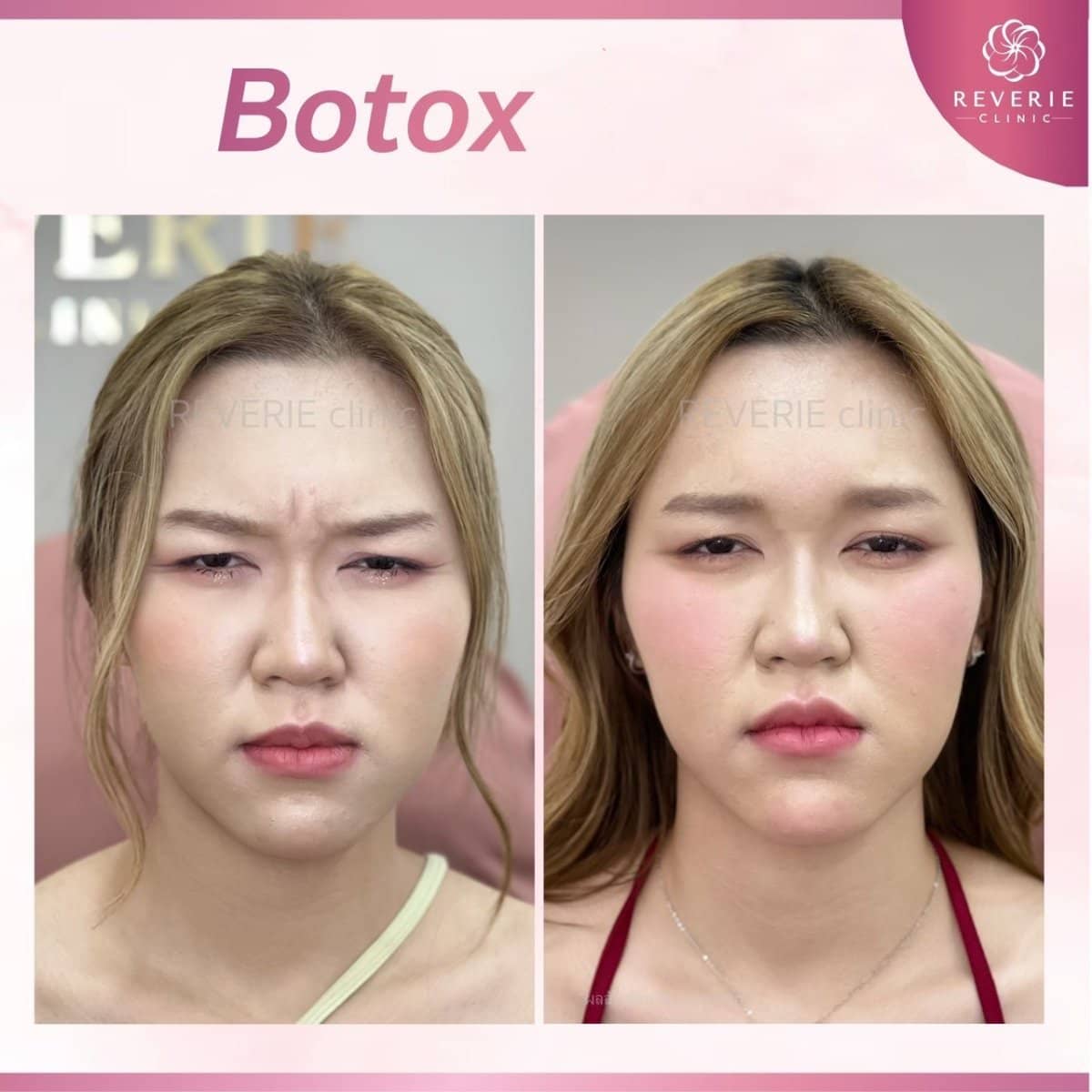 Case 19827 - Botox injections
