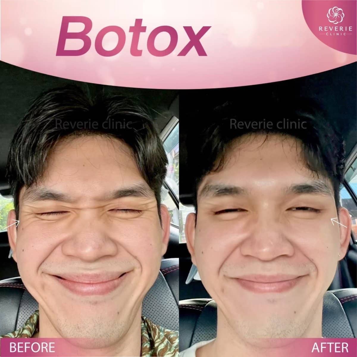 Case 19828 - Botox wrinkle treatment