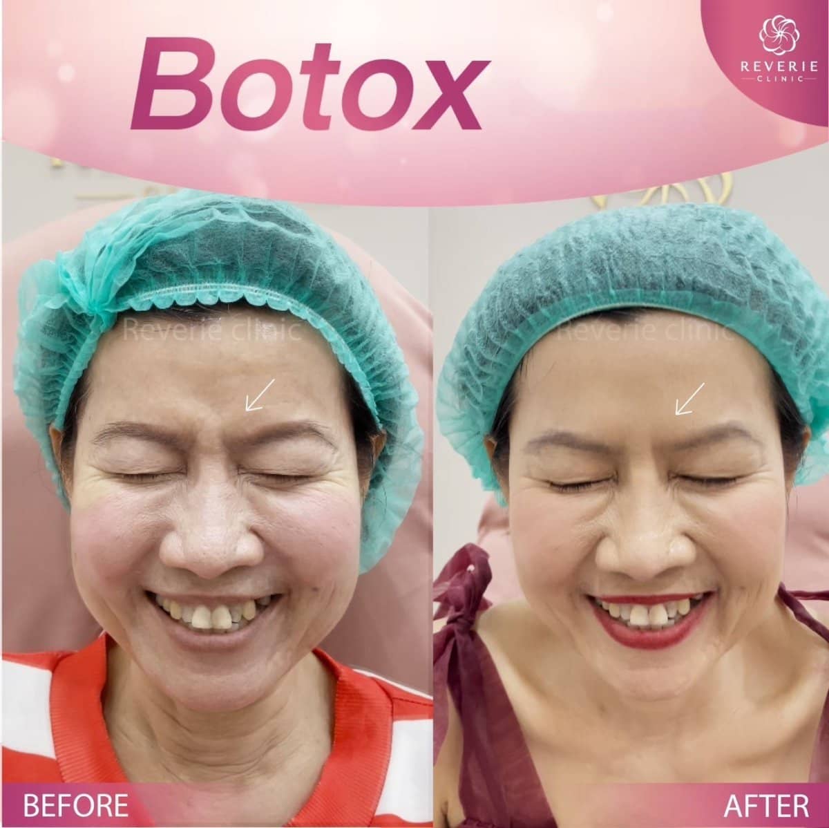 Case 19829 - Botox wrinkle treatment