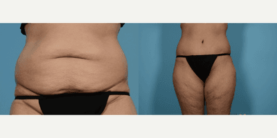 Case 1983 - Woman treated with Tummy Tuck