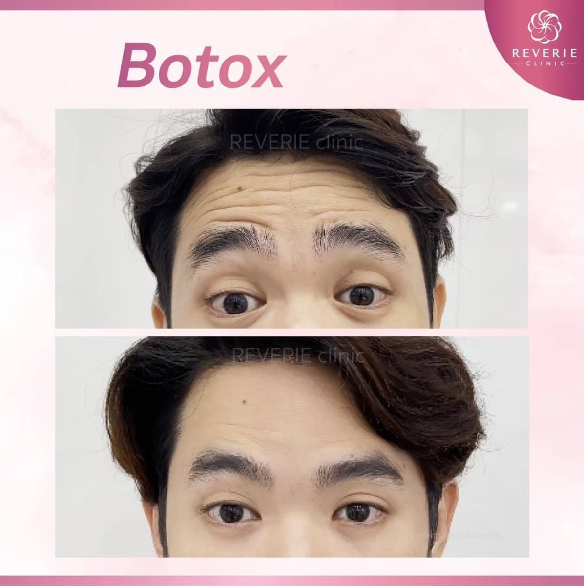 Case 19830 - Botox injections