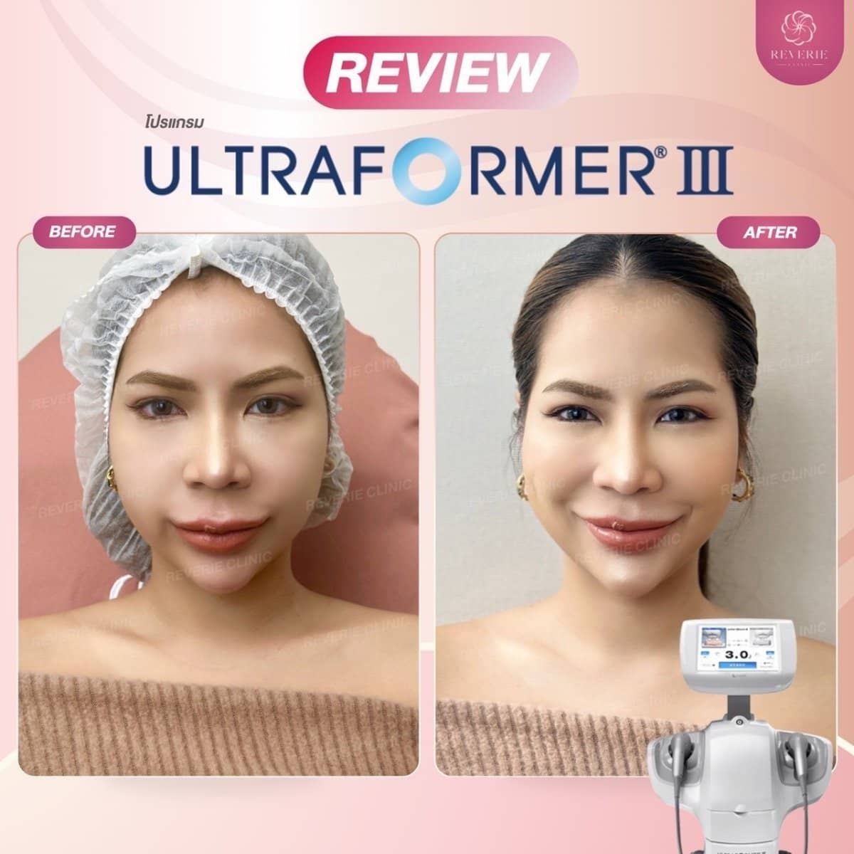 Case 19831 - nonsurgical facelift