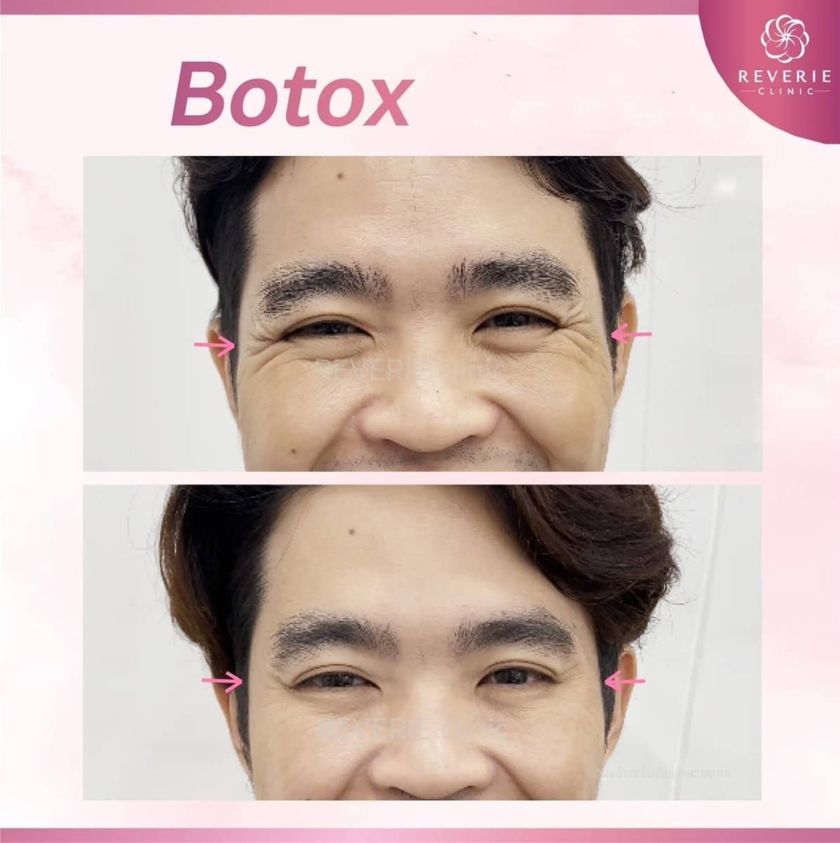 Case 19832 - Botox injections
